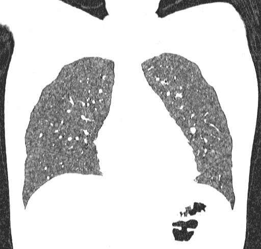 Acute hypersensitivity pneumonitis (Radiopaedia 85293-100870 Coronal lung window 36).jpg