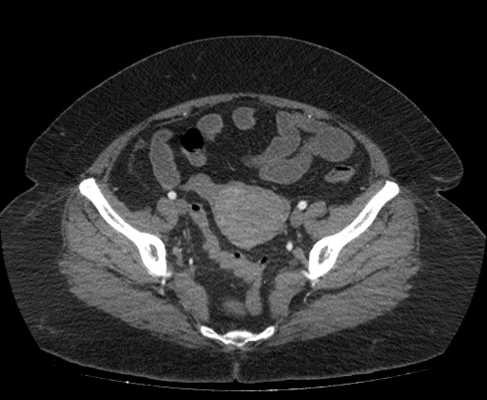 Acute mesenteric ischemia (Radiopaedia 80029-93316 Axial C+ arterial phase 109).jpg