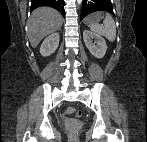 Acute mesenteric ischemia (Radiopaedia 80029-93316 Coronal C+ arterial phase 100).jpg