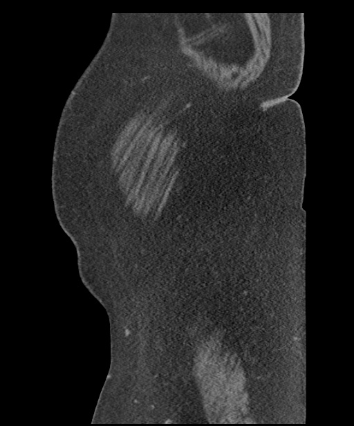 Acute mesenteric venous ischemia (Radiopaedia 46041-50383 Sagittal C+ portal venous phase 1).jpg