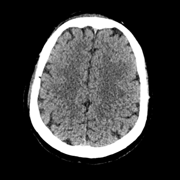 Acute middle cerebral artery territory infarct (Radiopaedia 52380-58283 Axial non-contrast 78).jpg