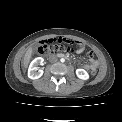 File:Acute myocarditis (Radiopaedia 55988-62613 Axial C+ portal venous phase 37).jpg