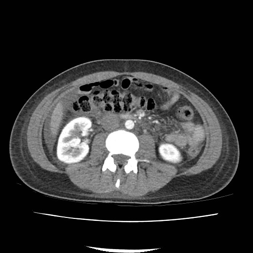 File:Acute myocarditis (Radiopaedia 55988-62613 Axial C+ portal venous phase 38).jpg
