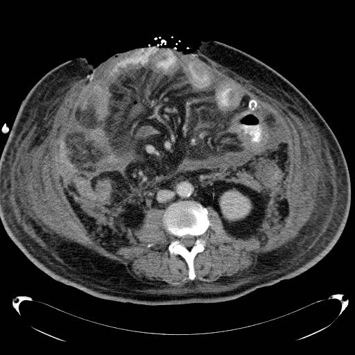 Acute pancreatic necrosis (Radiopaedia 13560-18503 Axial C+ portal venous phase 44).jpg