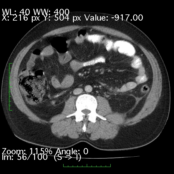 Acute pancreatitis (Radiopaedia 34043-35276 Axial C+ portal venous phase 56).jpg