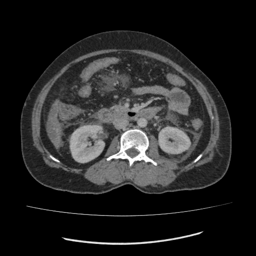 Acute pancreatitis (Radiopaedia 80007-93285 Axial C+ portal venous phase 93).jpg