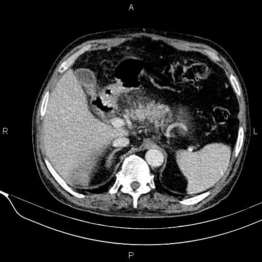 Acute pancreatitis (Radiopaedia 85146-100701 Axial C+ portal venous phase 21).jpg