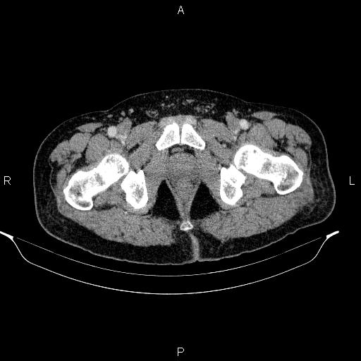 Acute pancreatitis (Radiopaedia 85390-101010 Axial C+ portal venous phase 111).jpg