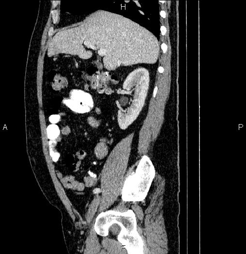 Acute pancreatitis (Radiopaedia 85390-101010 Sagittal C+ portal venous phase 32).jpg