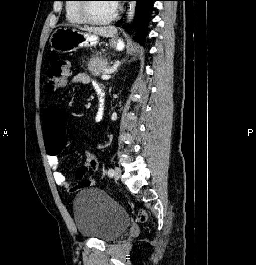 Acute pancreatitis (Radiopaedia 85390-101010 Sagittal C+ portal venous phase 61).jpg