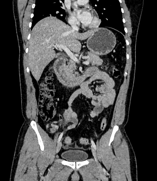 Acute pancreatitis (Radiopaedia 87428-103757 Coronal C+ portal venous phase 43).jpg