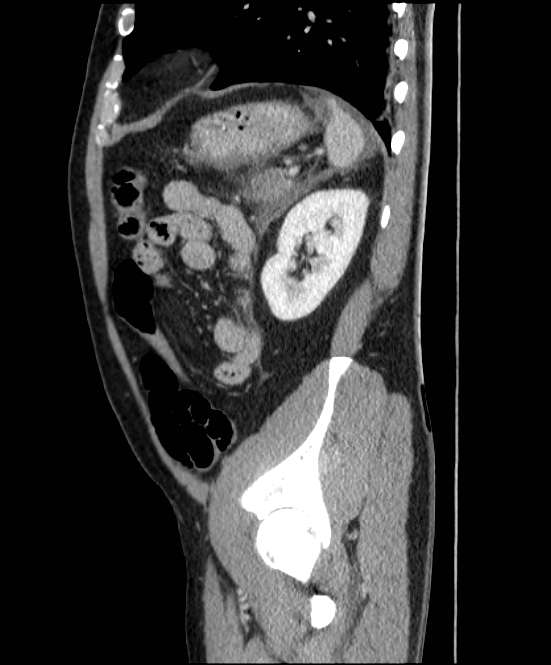 Acute pancreatitis - Balthazar E (Radiopaedia 23080-23110 Sagittal C+ portal venous phase 77).jpg