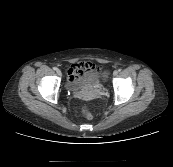 File:Acute pancreatitis - Balthazar E - post ERCP (Radiopaedia 27562-27772 Axial C+ portal venous phase 70).png