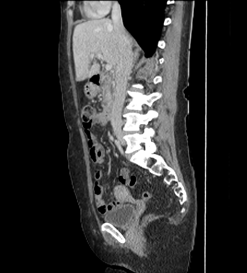 File:Acute pancreatitis - Balthazar E - post ERCP (Radiopaedia 27562-27772 Sagittal C+ portal venous phase 56).png