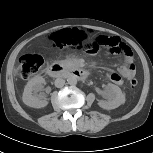 File:Acute pancreatitis and walled-off necrosis (Radiopaedia 29888-30404 Axial non-contrast 37).jpg