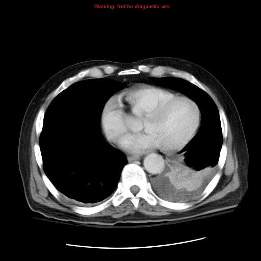 File:Acute pancreatitis with incidental pancreatic lipoma (Radiopaedia 10190-10730 Axial C+ portal venous phase 1).jpg