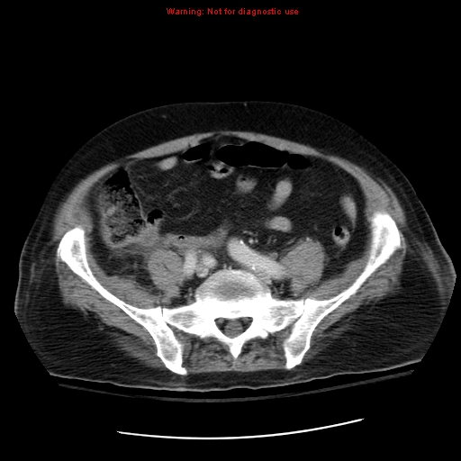 File:Acute pancreatitis with incidental pancreatic lipoma (Radiopaedia 10190-10730 Axial C+ portal venous phase 56).jpg
