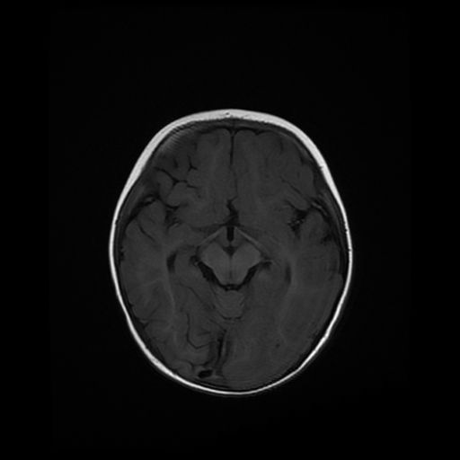 File:Acute phase of hemiconvulsion-hemiplegia epilepsy syndrome (Radiopaedia 29309-29745 Axial T1 14).jpg