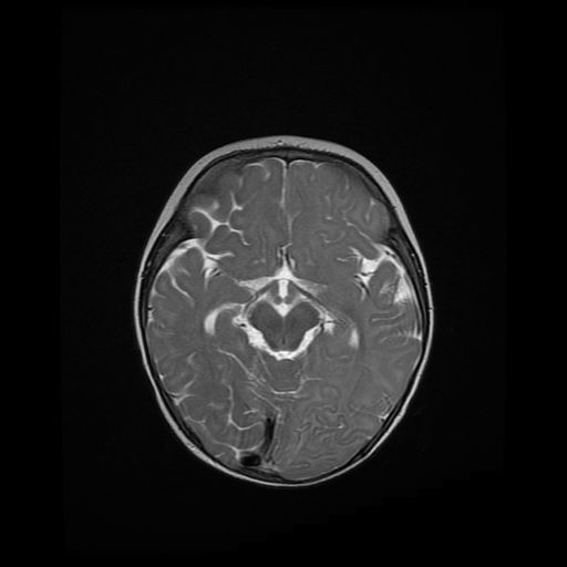 File:Acute phase of hemiconvulsion-hemiplegia epilepsy syndrome (Radiopaedia 29309-29745 Axial T2 14).jpg