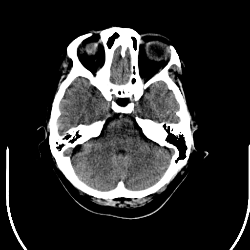 File:Acute pontine infarct from vertebral artery dissection (Radiopaedia 34111-35369 Axial non-contrast 7).png
