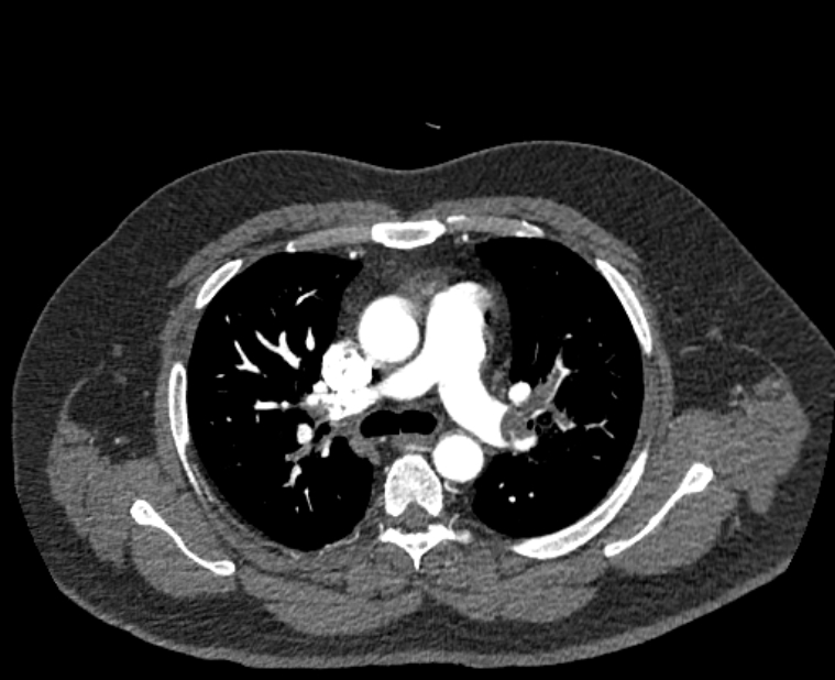 Acute pulmonary embolism with pulmonary infarcts (Radiopaedia 77688-89908 Axial C+ CTPA 23).jpg
