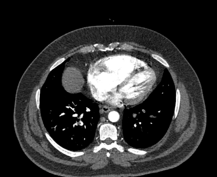 Acute pulmonary embolism with pulmonary infarcts (Radiopaedia 77688-89908 Axial C+ CTPA 45).jpg