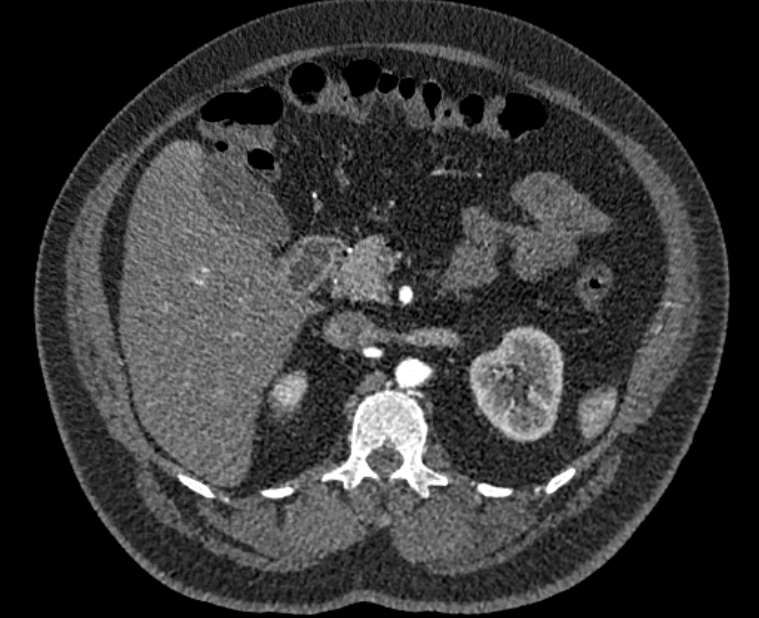 Acute pulmonary embolism with pulmonary infarcts (Radiopaedia 77688-89908 Axial C+ CTPA 86).jpg