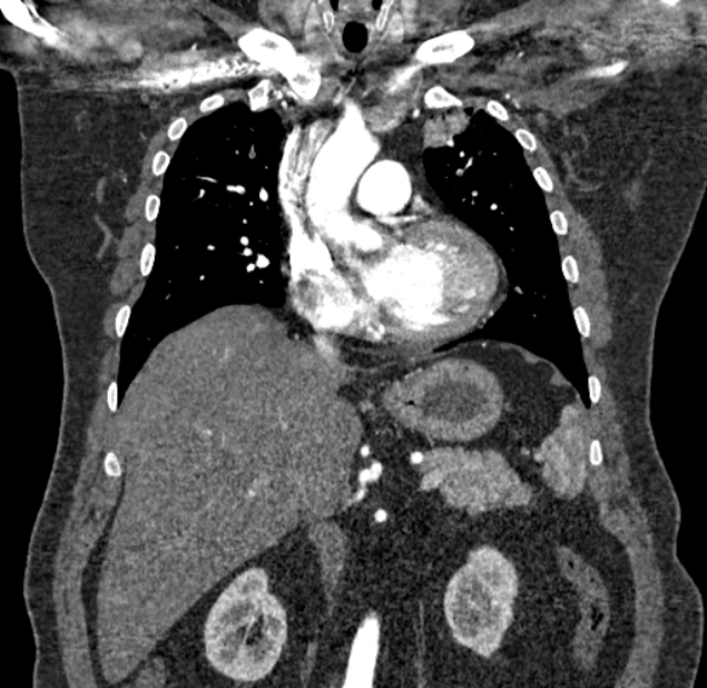 Acute pulmonary embolism with pulmonary infarcts (Radiopaedia 77688-89908 Coronal C+ CTPA 35).jpg
