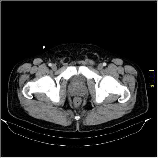 Acute right sided diverticulitis (Radiopaedia 65249-74268 Axial C+ portal venous phase 79).JPG