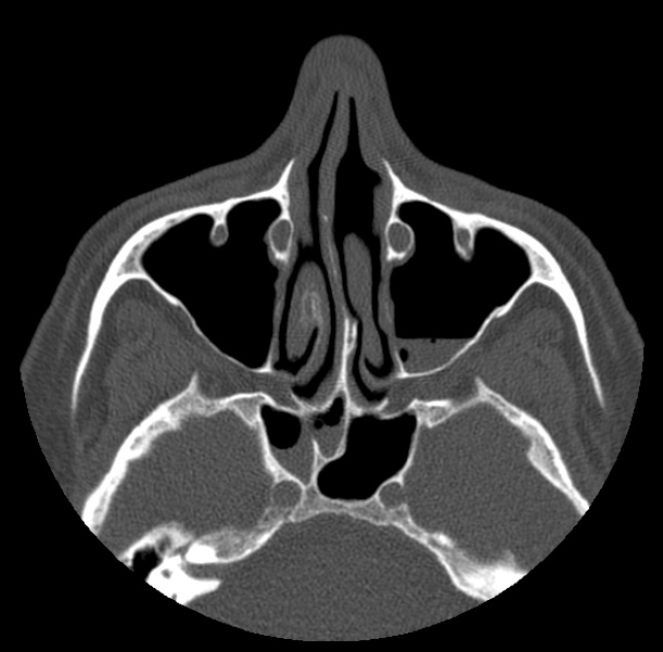 Acute sinusitis (Radiopaedia 23161-23215 Axial bone window 30).jpg