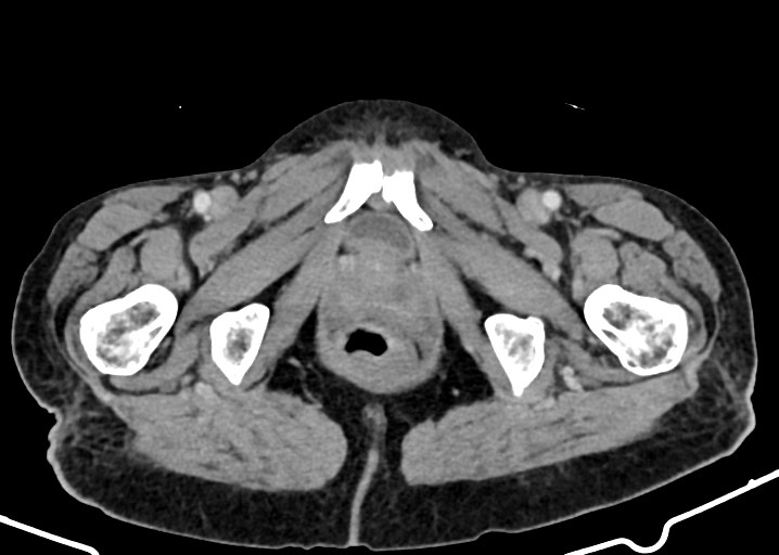 File:Acute small bowel (ileal) volvulus (Radiopaedia 71740-82139 Axial C+ portal venous phase 203).jpg