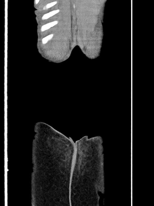 Acute small bowel (ileal) volvulus (Radiopaedia 71740-82139 Coronal C+ portal venous phase 112).jpg
