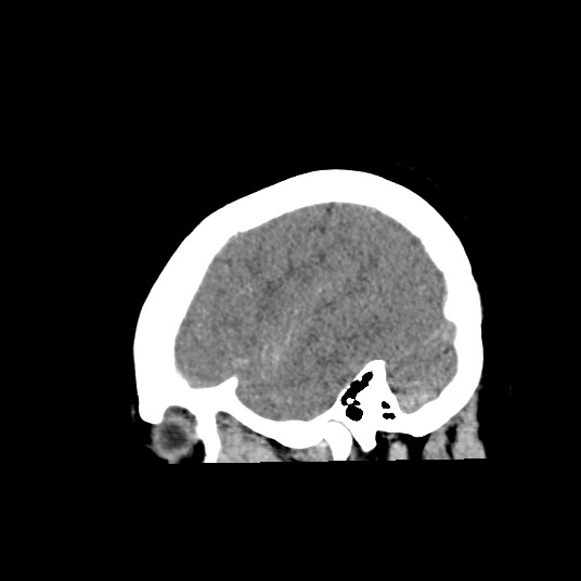 Acute subarachnoid hemorrhage and accessory anterior cerebral artery (Radiopaedia 69231-79008 Sagittal non-contrast 47).jpg