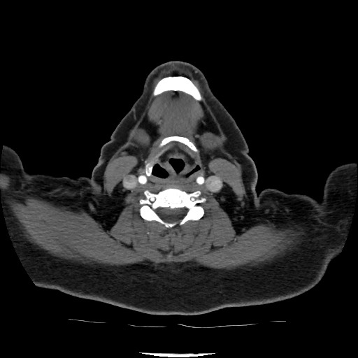 Acute subarachnoid hemorrhage and accessory anterior cerebral artery (Radiopaedia 69231-79009 Axial C+ arterial phase 46).jpg