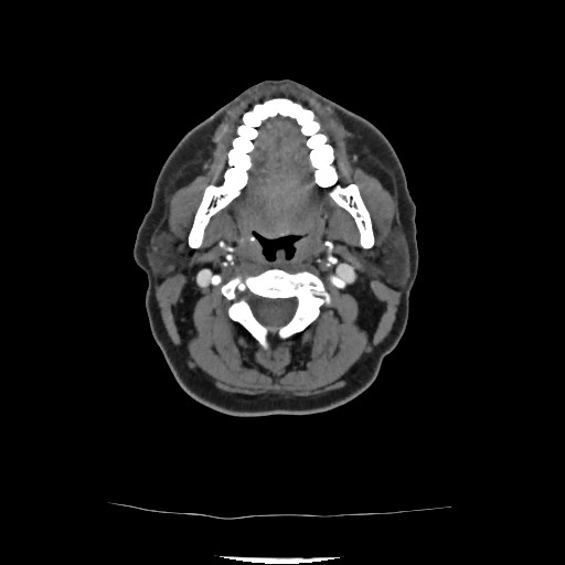 Acute subarachnoid hemorrhage and accessory anterior cerebral artery (Radiopaedia 69231-79009 Axial C+ arterial phase 62).jpg
