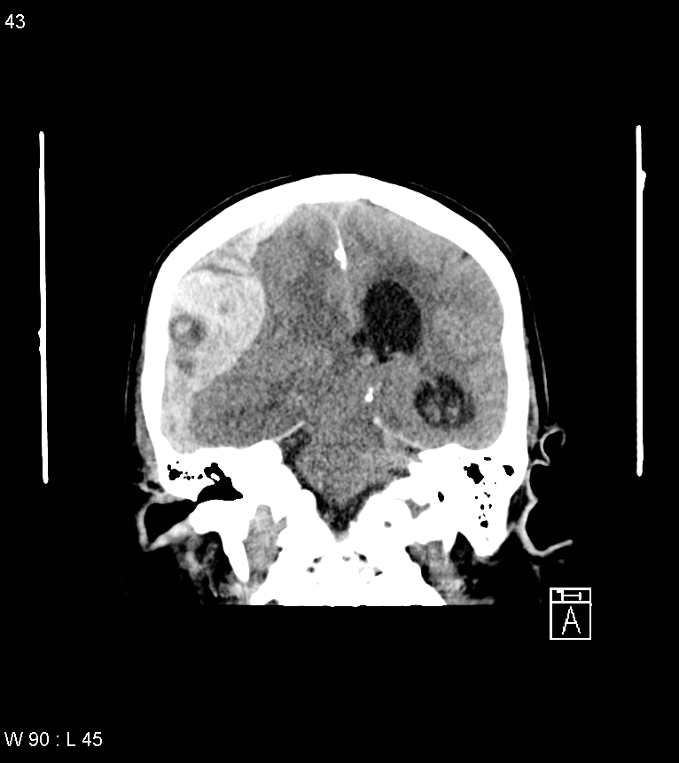 Acute subdural hematoma with myelofibrosis (Radiopaedia 52582-58494 Coronal non-contrast 34).jpg