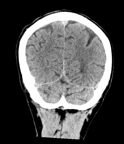 File:Acute superior cerebellar artery territory infarct (Radiopaedia 84104-99359 Coronal non-contrast 70).jpg