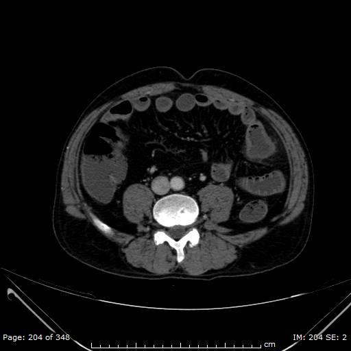 Acute superior mesenteric artery occlusion (Radiopaedia 43636-47060 Axial C+ portal venous phase 34).jpg
