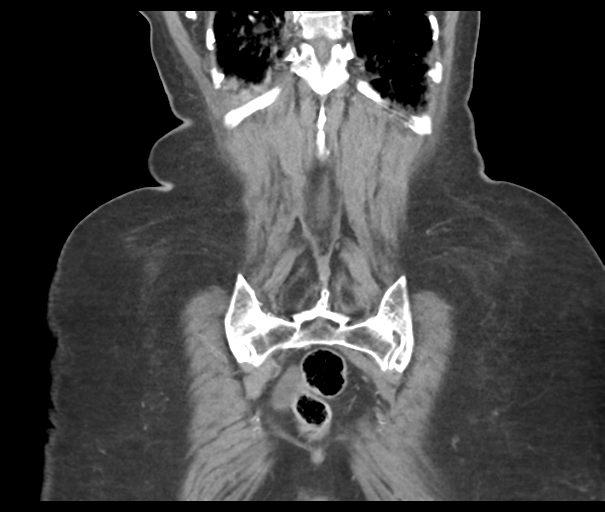 File:Acute superior mesenteric artery occlusion (Radiopaedia 43926-47418 Coronal C+ portal venous phase 44).png