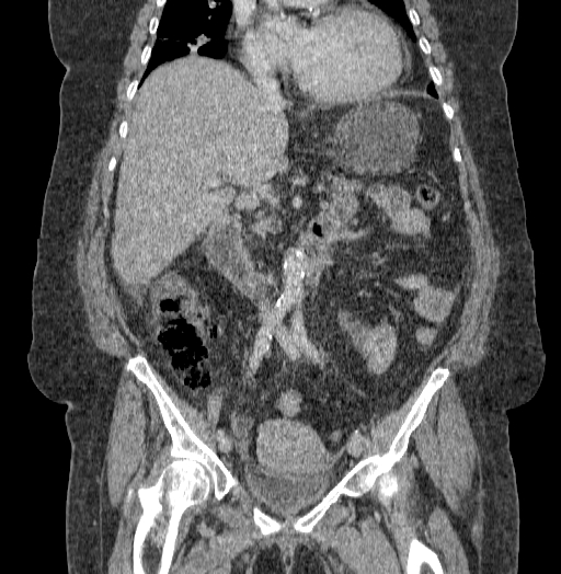 Acute superior mesenteric artery occlusion (Radiopaedia 51288-56960 Coronal C+ portal venous phase 39).jpg