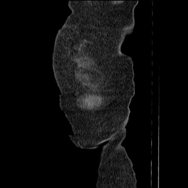 Acute tubular necrosis (Radiopaedia 28077-28334 Sagittal non-contrast 3).jpg