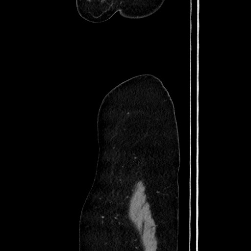 File:Acute uncomplicated appendicitis (Radiopaedia 73704-84499 Sagittal C+ portal venous phase 31).jpg