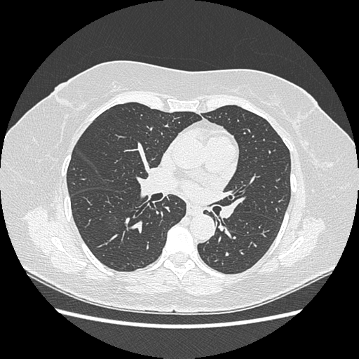 Adenocarcinoma in situ of lung (Radiopaedia 38685-40829 B 113).png