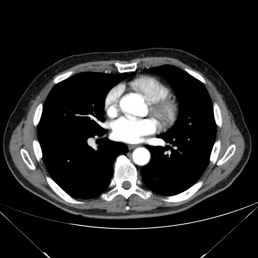 Adenocarcinoma of the lung (Radiopaedia 59871-67325 Axial C+ arterial phase 53).jpg