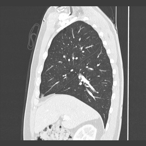 Adenocarcinoma of the lung (Radiopaedia 59871-67325 Sagittal lung window 30).jpg