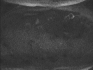 Adenocarcioma of rectum- T1 lesion (Radiopaedia 36921-38546 Axial DWI 83).png