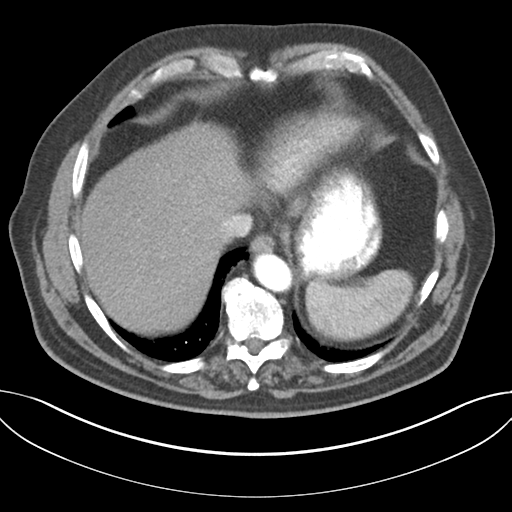 Adenocarcioma of rectum- T1 lesion (Radiopaedia 36921-38547 Axial C+ arterial phase 45).png
