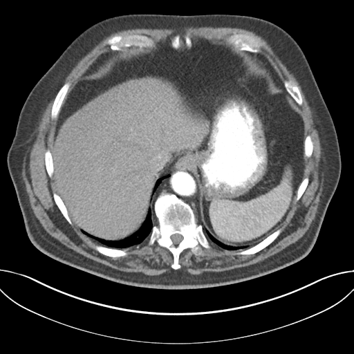 Adenocarcioma of rectum- T1 lesion (Radiopaedia 36921-38547 Axial C+ arterial phase 47).png