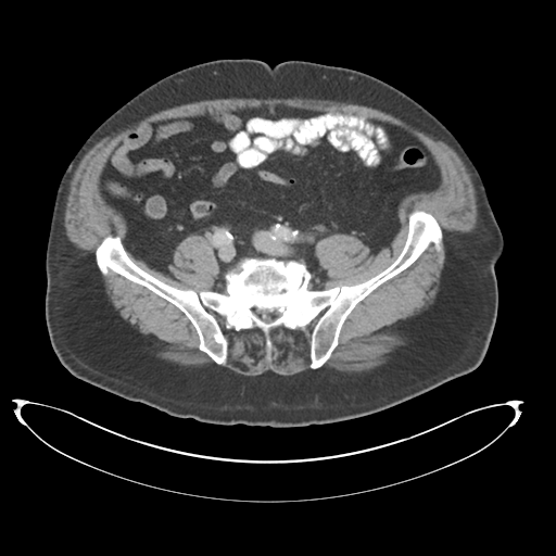 Adenocarcioma of rectum- T1 lesion (Radiopaedia 36921-38547 Axial C+ portal venous phase 63).png