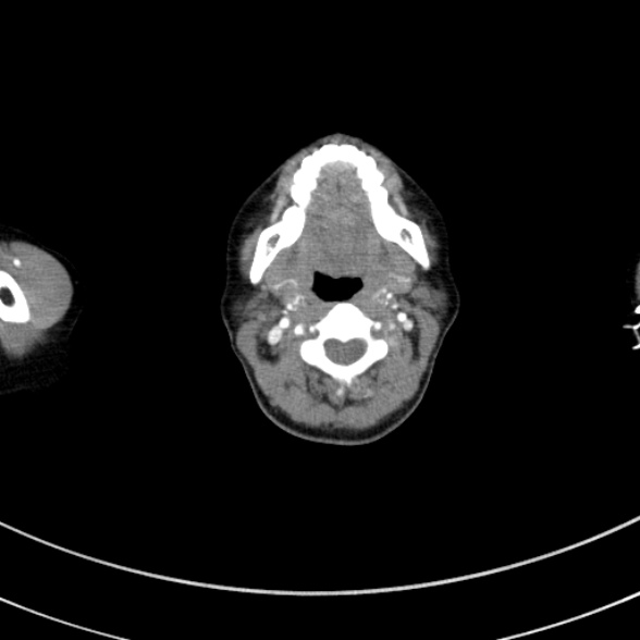 Adenocystic carcinoma of the trachea (Radiopaedia 47677-52525 Axial C+ arterial phase 12).jpg